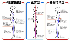 腰痛を引き出す体型